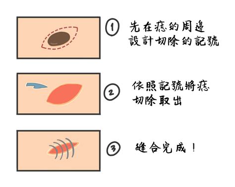 胸口紅痣|痣